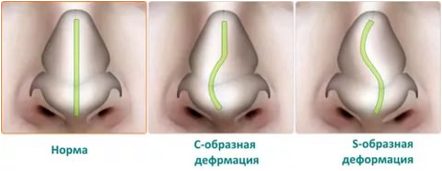Викривлення носової перегородки 1 image 13
