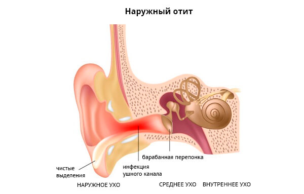 Отит 2 image 4
