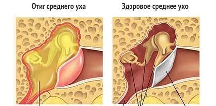 Отит 3 image 5